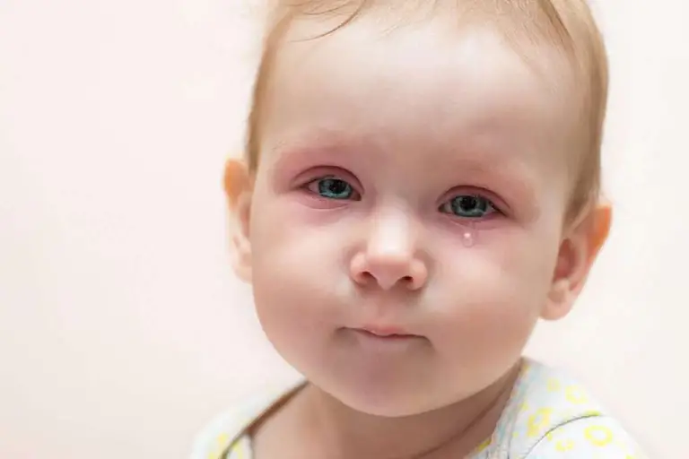 Baby Eye Infection Yellow Discharge