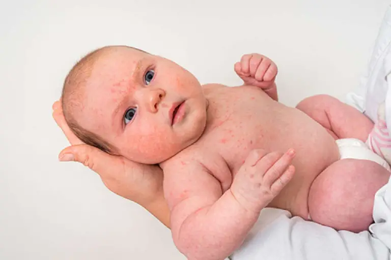 What to Do when baby boy rash on private area?